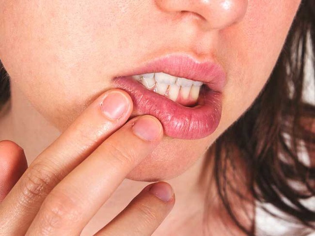 Nhiệt miệng liên tục xảy ra do đâu? Chế độ dinh dưỡng không phải nguyên nhân duy nhất gây nhiệt miệng - Ảnh 3.