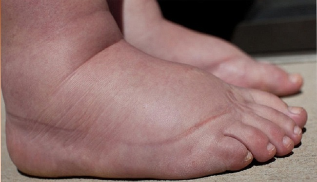 Sưng phù ở bàn chân kể cả khi đã uống thuốc lợi tiểu là dấu hiệu của bệnh suy tim ở người già (Ảnh: Internet)