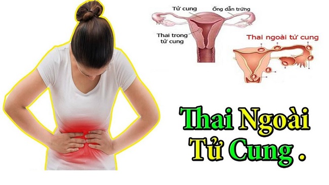 Nguyên nhân nào gây ra hiện tượng đau bụng khi mang thai? - Ảnh 2.