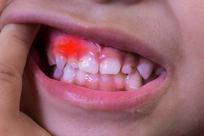 Thông tin từ A đến Z về hiện tượng mọc mụn ở nướu răng - Ảnh 5.