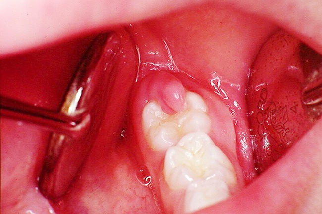Tất tần tật thông tin từ A tới Z về sưng nướu răng - Ảnh 1.
