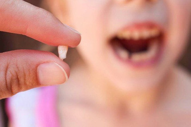 Tự nhổ răng sữa tại nhà, răng bé gái 8 tuổi bị rơi vào phổi dẫn tới viêm phổi nặng - Ảnh 4.