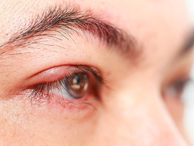 Các bệnh về mắt thường gặp trong mùa hè