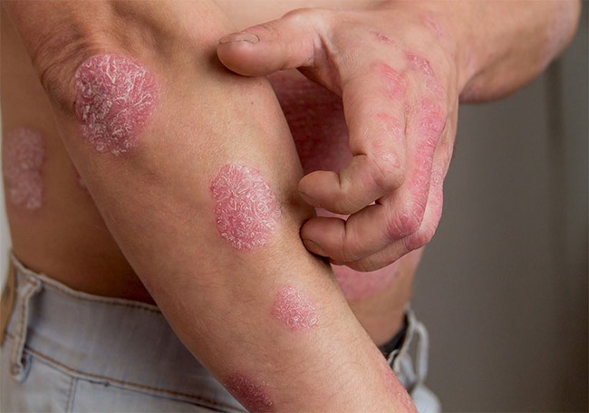 Tìm hiểu 10 bệnh ngứa ngoài da vào mùa hè thường gặp - Ảnh 3.