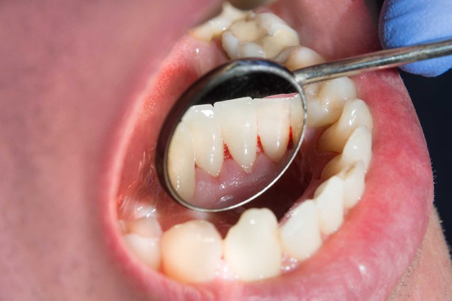 Mối liên hệ giữa Covid-19 và sức khỏe răng miệng - Ảnh 2.