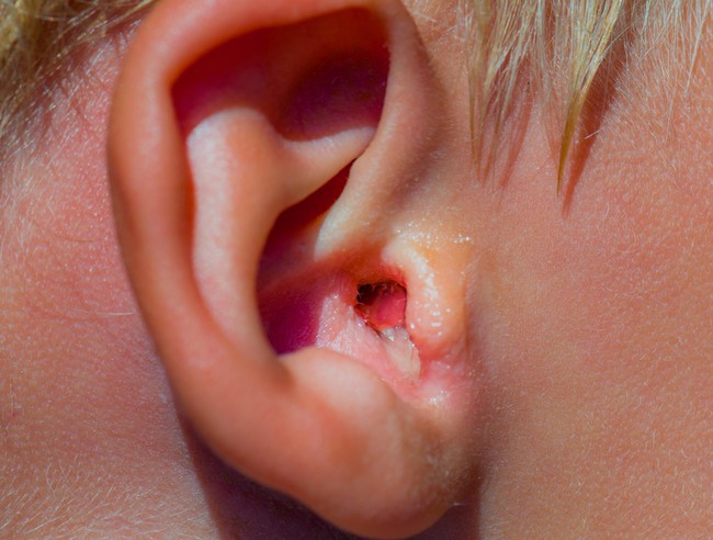 Viêm tai ngoài (Swimmer’s ear) mùa nắng nóng: Nhận biết dấu hiệu sớm và cách phòng ngừa