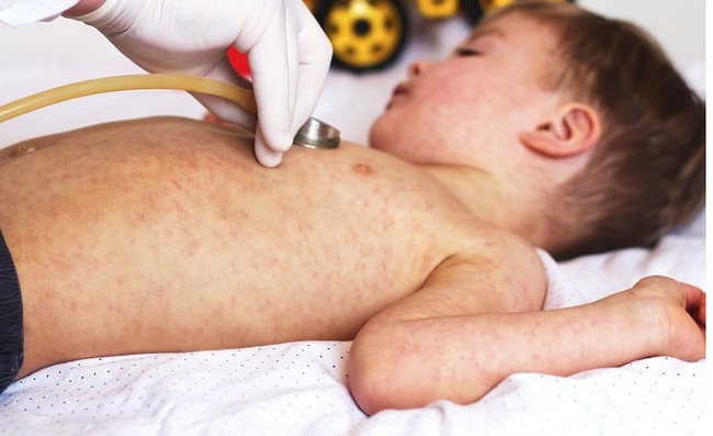 Trẻ bị sốt rubella cần làm gì? Dấu hiệu và cách xử lý - Ảnh 2.