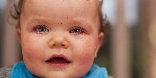 Những bệnh đau mắt ở trẻ sơ sinh phổ biến - Ảnh 2.