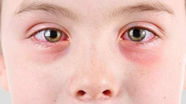 Rách giác mạc mắt: Nguyên nhân, chẩn đoán và cách phòng ngừa, điều trị  - Ảnh 1.