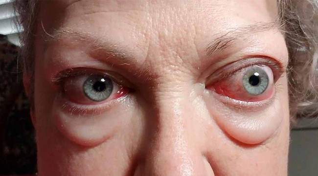 Bệnh mắt lồi: Nguyên nhân, triệu chứng và cách điều trị bệnh - Ảnh 1.