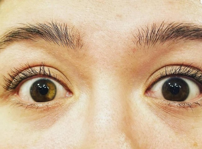 Loạn sắc tố mống mắt (Heterochromia Iridium): Nguyên nhân, dấu hiệu và cách điều trị - Ảnh 1.