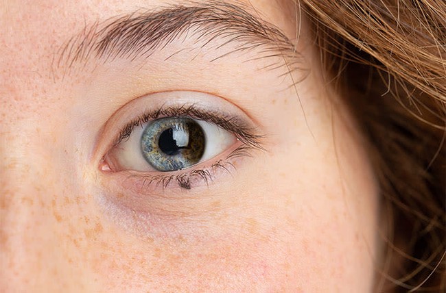 Loạn sắc tố mống mắt (Heterochromia Iridium): Nguyên nhân, dấu hiệu và cách điều trị - Ảnh 2.