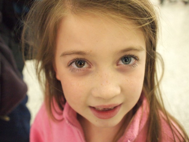 Loạn sắc tố mống mắt (Heterochromia Iridium): Nguyên nhân, dấu hiệu và cách điều trị - Ảnh 4.