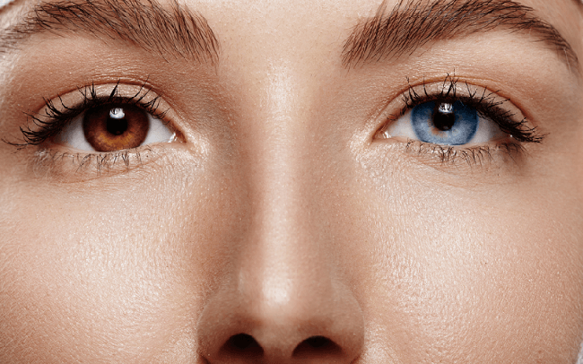 Loạn sắc tố mống mắt (Heterochromia Iridium): Nguyên nhân, dấu hiệu và cách điều trị - Ảnh 5.