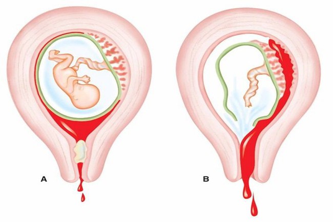 Bế sản dịch sau sinh: Nguyên nhân, triệu chứng và cách điều trị - Ảnh 1.