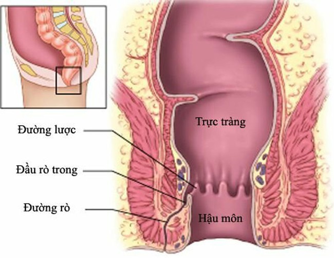 Rò hậu môn: Nguyên nhân, tác hại và cách điều trị bệnh - Ảnh 1.