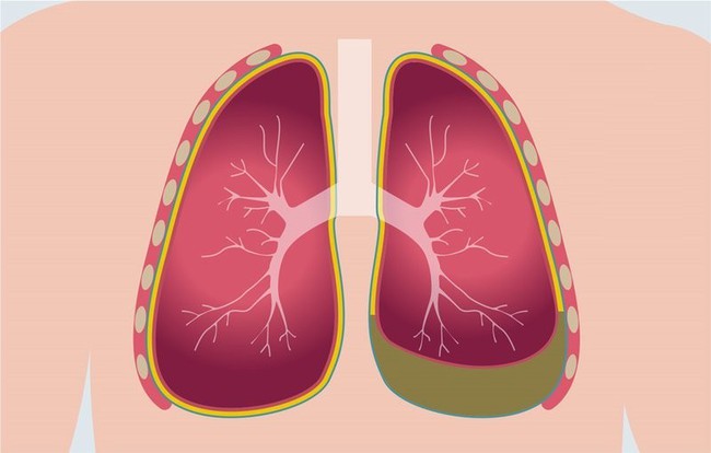 Tràn dịch màng phổi là gì? Nguyên nhân, triệu chứng và cách điều trị tràn dịch màng phổi - Ảnh 1.
