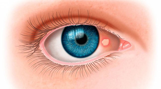 Ung thư mắt: Tất tần tật những điều cần biết về căn bệnh nguy hiểm này - Ảnh 1.