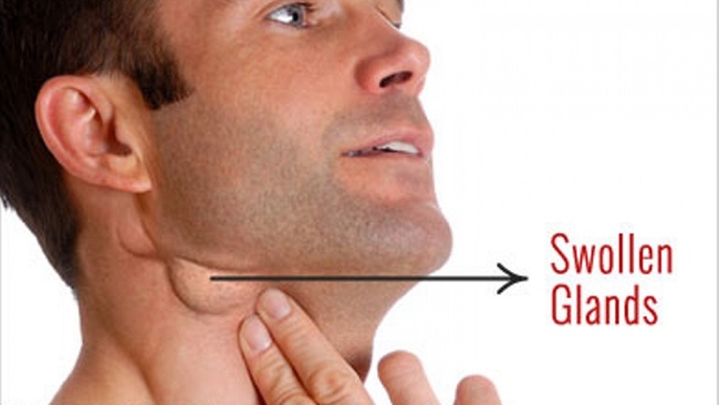 Các triệu chứng ung thư vòm họng thường gặp, phương pháp chẩn đoán và cách phòng ngừa - Ảnh 2.