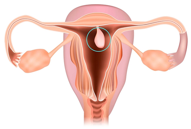 Polyp cổ tử cung: Nguyên nhân, triệu chứng và cách điều trị bệnh - Ảnh 1.