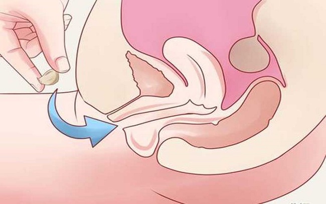 Viêm cổ tử cung: Nguyên nhân, triệu chứng và cách điều trị bệnh - Ảnh 3.