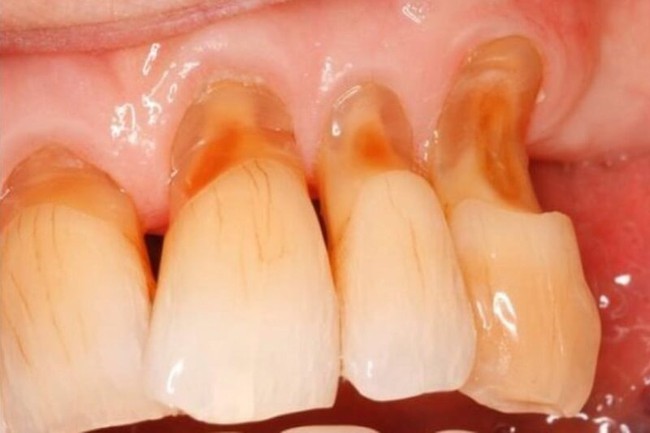 Tại sao răng bị mục? Những thông tin cần biết về tình trạng răng bị mục - Ảnh 1.