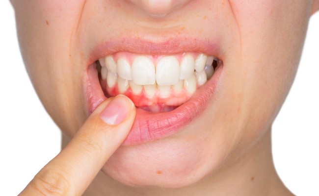 Chảy máu chân răng: Nguyên nhân và hướng xử trí - Ảnh 2.