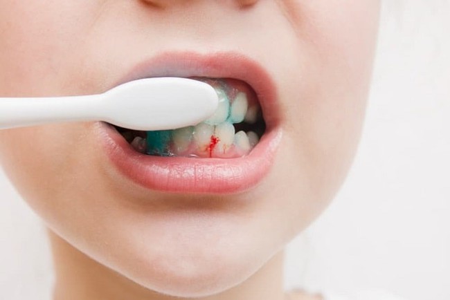 Chảy máu chân răng: Nguyên nhân và hướng xử trí - Ảnh 3.