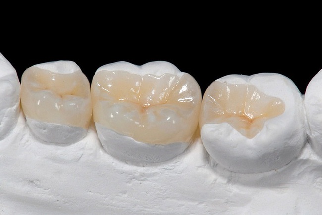 Tại sao răng bị mục? Những thông tin cần biết về tình trạng răng bị mục - Ảnh 3.