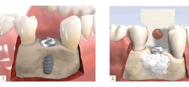 Răng vĩnh viễn bị lung lay: Nguyên nhân và biện pháp khắc phục - Ảnh 6.