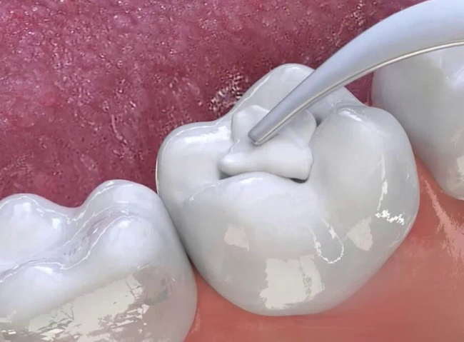 Răng bị mòn mặt nhai: Nguyên nhân, khắc phục và biện pháp phòng ngừa - Ảnh 3.