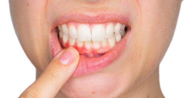 Răng vĩnh viễn bị lung lay: Nguyên nhân và biện pháp khắc phục - Ảnh 5.