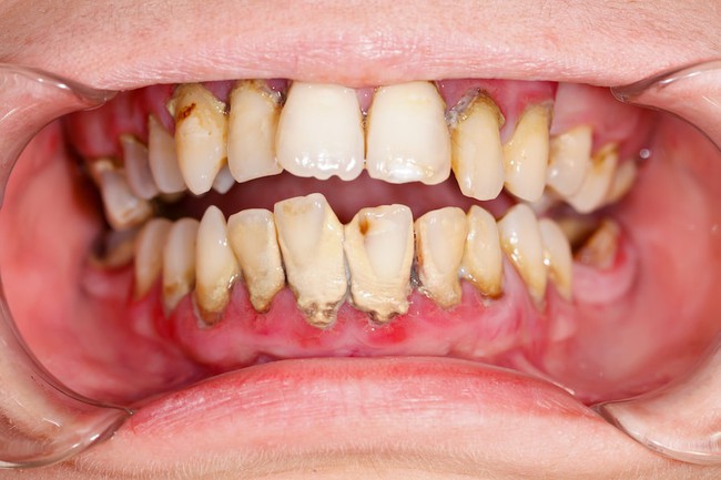 Nguyên nhân và hướng điều trị tình trạng chân răng bị đen - Ảnh 2.