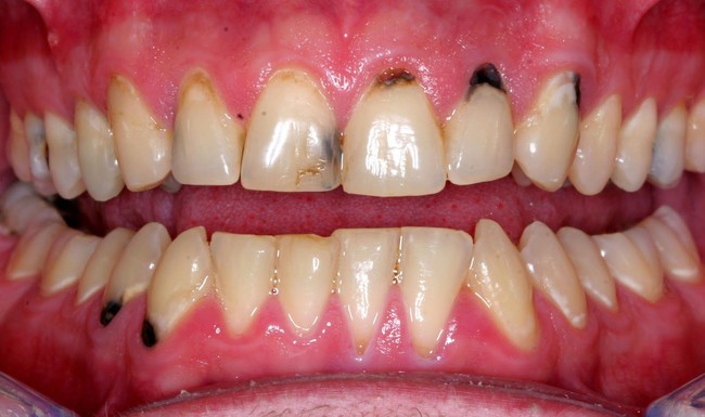 Nguyên nhân và hướng điều trị tình trạng chân răng bị đen - Ảnh 3.