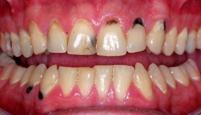 Kẽ răng bị đen: Nguyên nhân và cách điều trị - Ảnh 1.