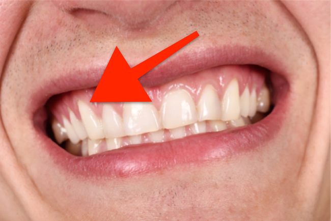 Tụt nướu răng là gì? Gợi ý cách trị tụt nướu răng tại nhà hiệu quả - Ảnh 4.