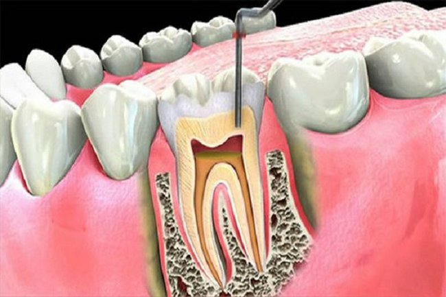 Tìm hiểu răng đã lấy tủy tồn tại được bao lâu? - Ảnh 1.