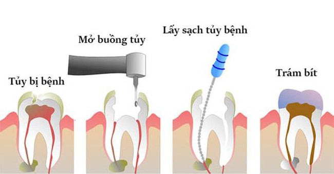 Răng chết tủy phải làm sao? Dấu hiệu, nguyên nhân và cách điều trị  răng chết tủy - Ảnh 4.