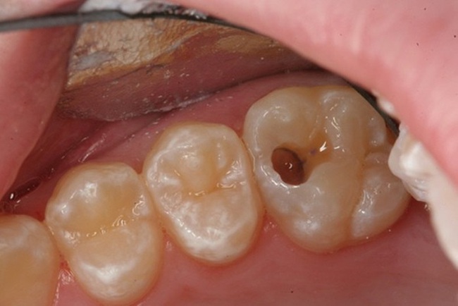Răng chết tủy phải làm sao? Dấu hiệu, nguyên nhân và cách điều trị  răng chết tủy - Ảnh 2.