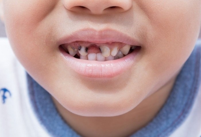 Điểm danh các bệnh về răng miệng phổ biến và cách phòng ngừa - Ảnh 1.