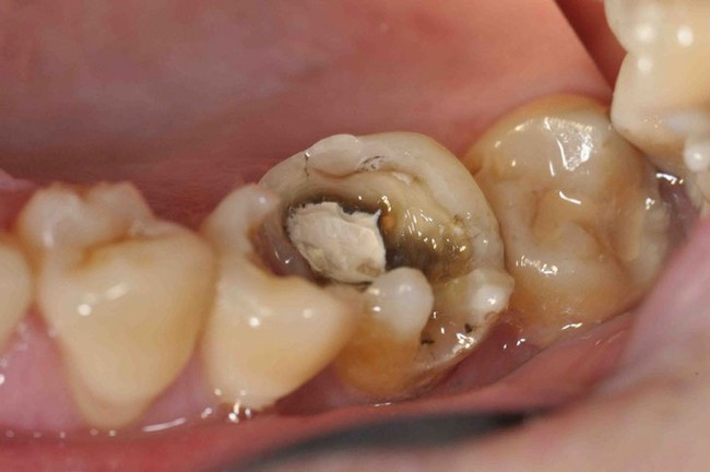 Răng chết tủy phải làm sao? Dấu hiệu, nguyên nhân và cách điều trị  răng chết tủy - Ảnh 3.