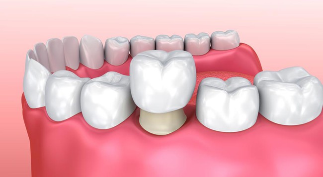 Những thông tin cần biết về hiện tượng răng cửa mọc lệch - Ảnh 5.