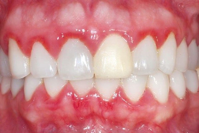 Giải đáp thắc mắc: có nên tẩy trắng răng? Tẩy trắng răng có an toàn không? - Ảnh 6.