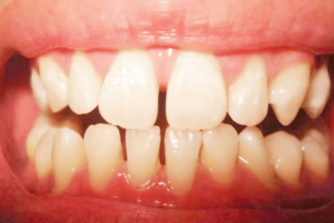 Răng không đều phải làm sao? Bật mí những cách chỉnh nha để có hàm răng đẹp - Ảnh 1.