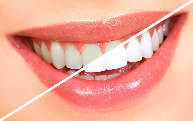 Giải đáp thắc mắc: có nên tẩy trắng răng? Tẩy trắng răng có an toàn không? - Ảnh 4.