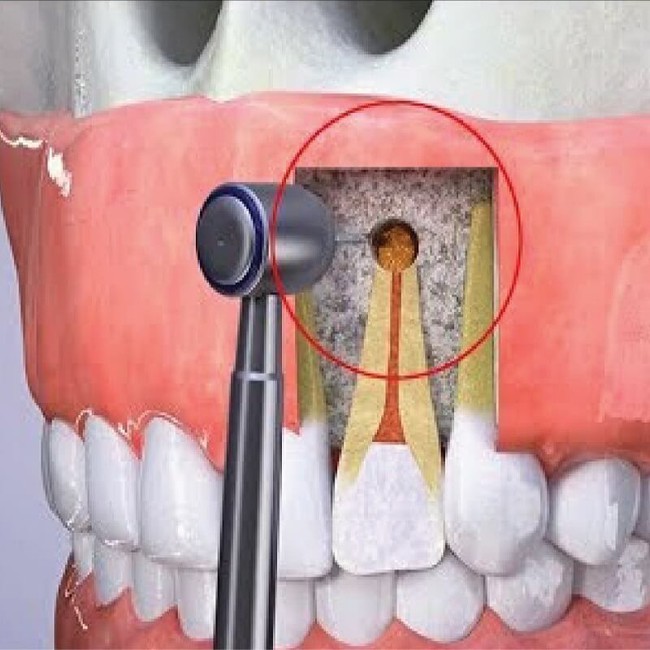 Phẫu thuật cắt chóp răng là gì? Cắt chóp răng có nguy hiểm không và bao lâu thì lành? - Ảnh 3.