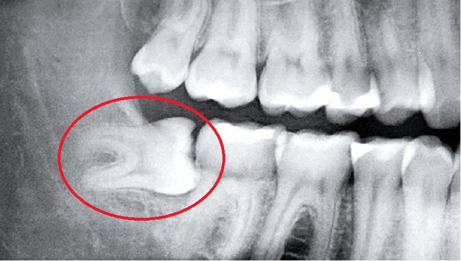 Tìm hiểu về chụp X quang răng và những điều cần lưu ý - Ảnh 2.