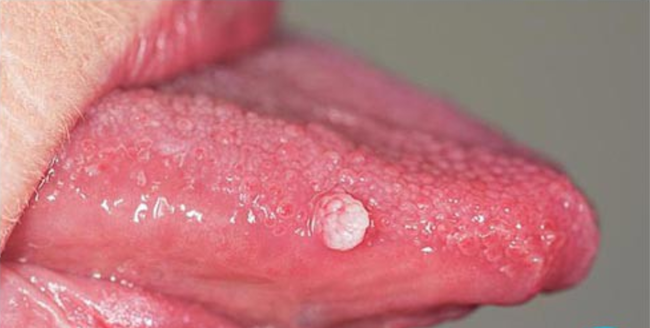 Sùi mào gà ở lưỡi: Nguyên nhân, triệu chứng và cách điều trị bệnh - Ảnh 1.