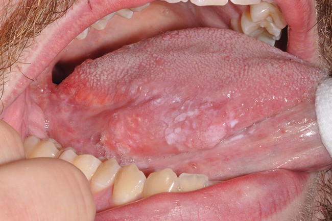 Sùi mào gà ở lưỡi: Nguyên nhân, triệu chứng và cách điều trị bệnh - Ảnh 2.