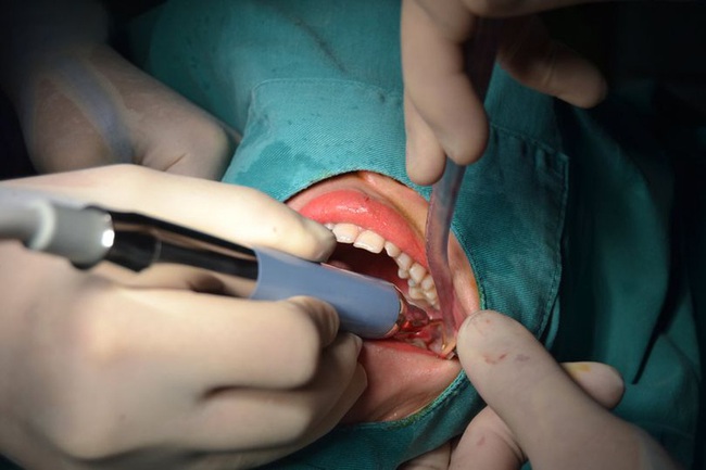 Tìm hiểu về tiểu phẫu nhổ răng khôn: Có đau không? Bao lâu thì lành? - Ảnh 3.